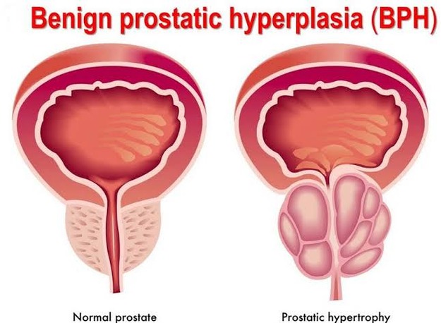 BPH