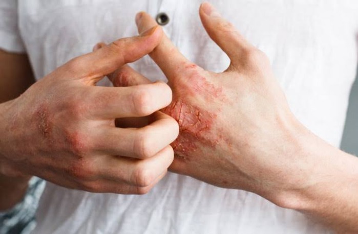 Eczema